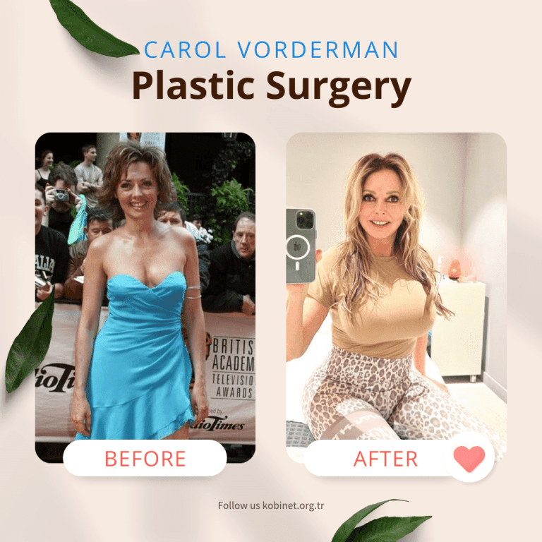 Carol Vorderman Plastic Surgery