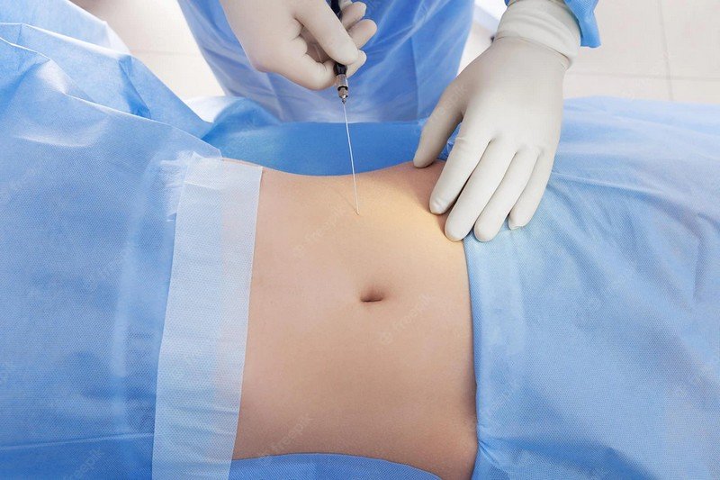 Liposuction