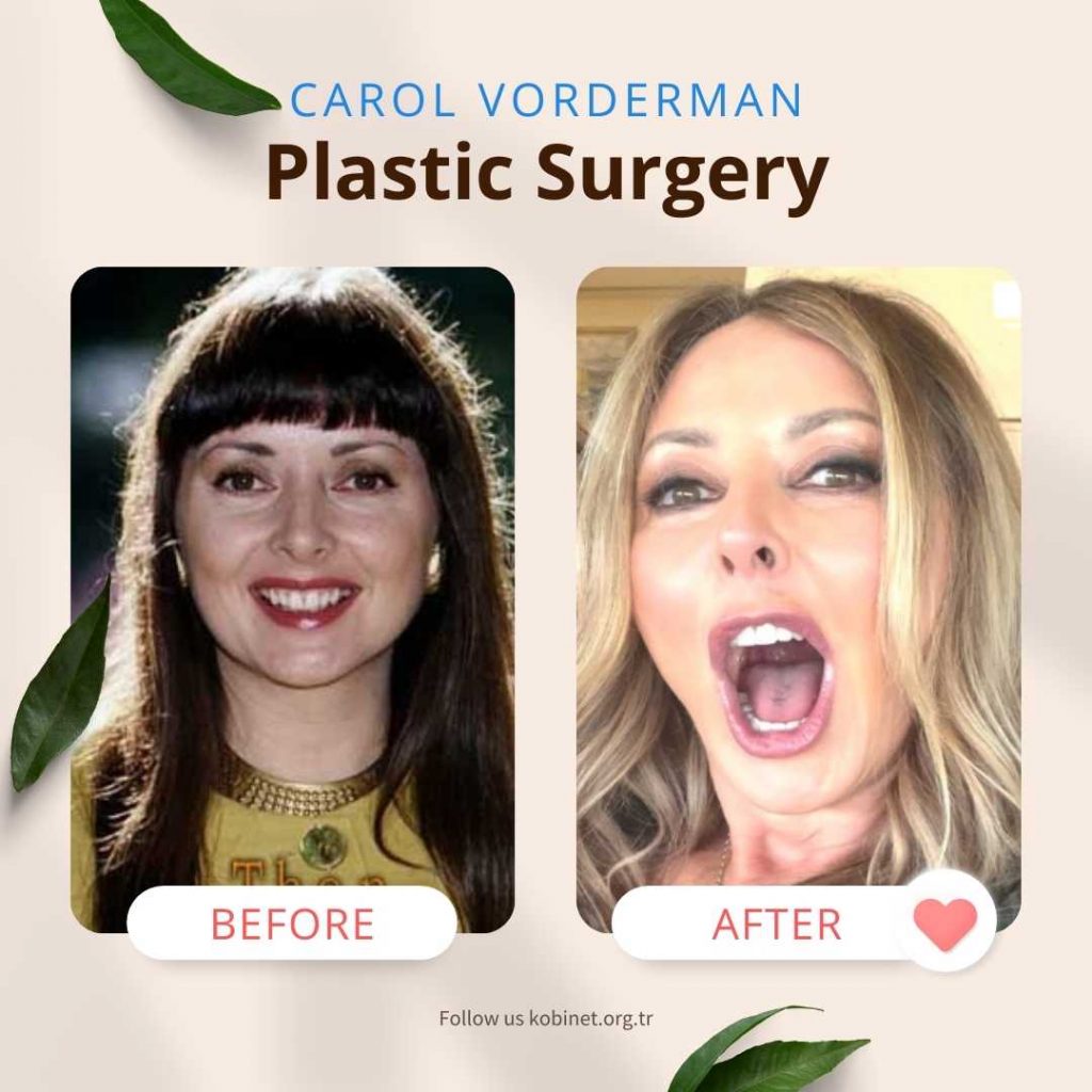 Carol Vorderman Plastic Surgery