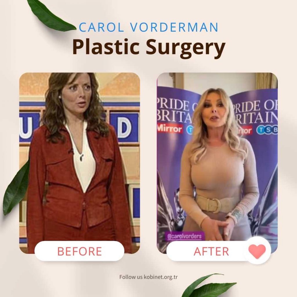 carol vonderman plastic surgery 2022