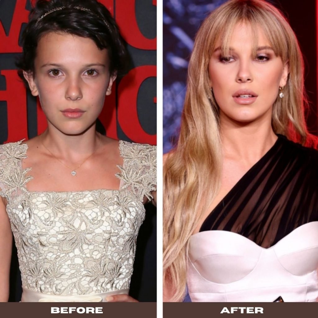 Did Millie Bobby Brown get plastic surgery?