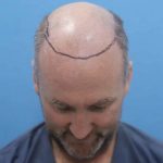 7000 grafts hair transplant