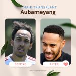 Aubameyang’s Hair Transplant