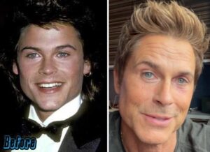 Has Rob Lowe had plastic surgery?