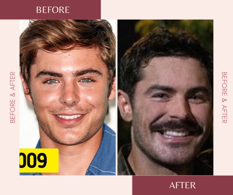 Zac Efrons Incredible Transformation All You Need To Know About His Plastic Surgeries 