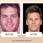 Tom Brady before after