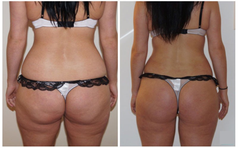Before and After Images of Buttock Augmentation Procedures